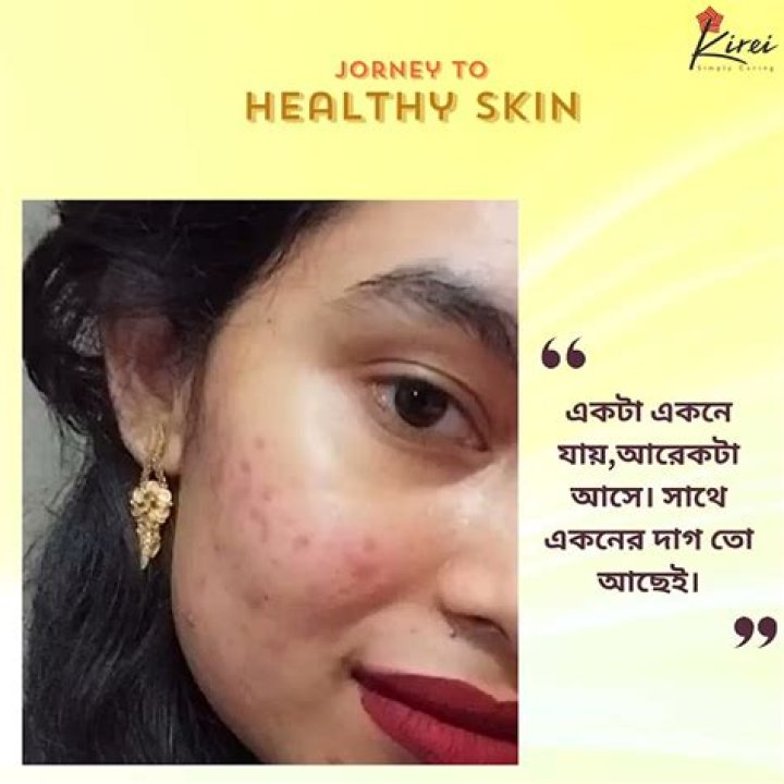 A Journey To Healthy Skin